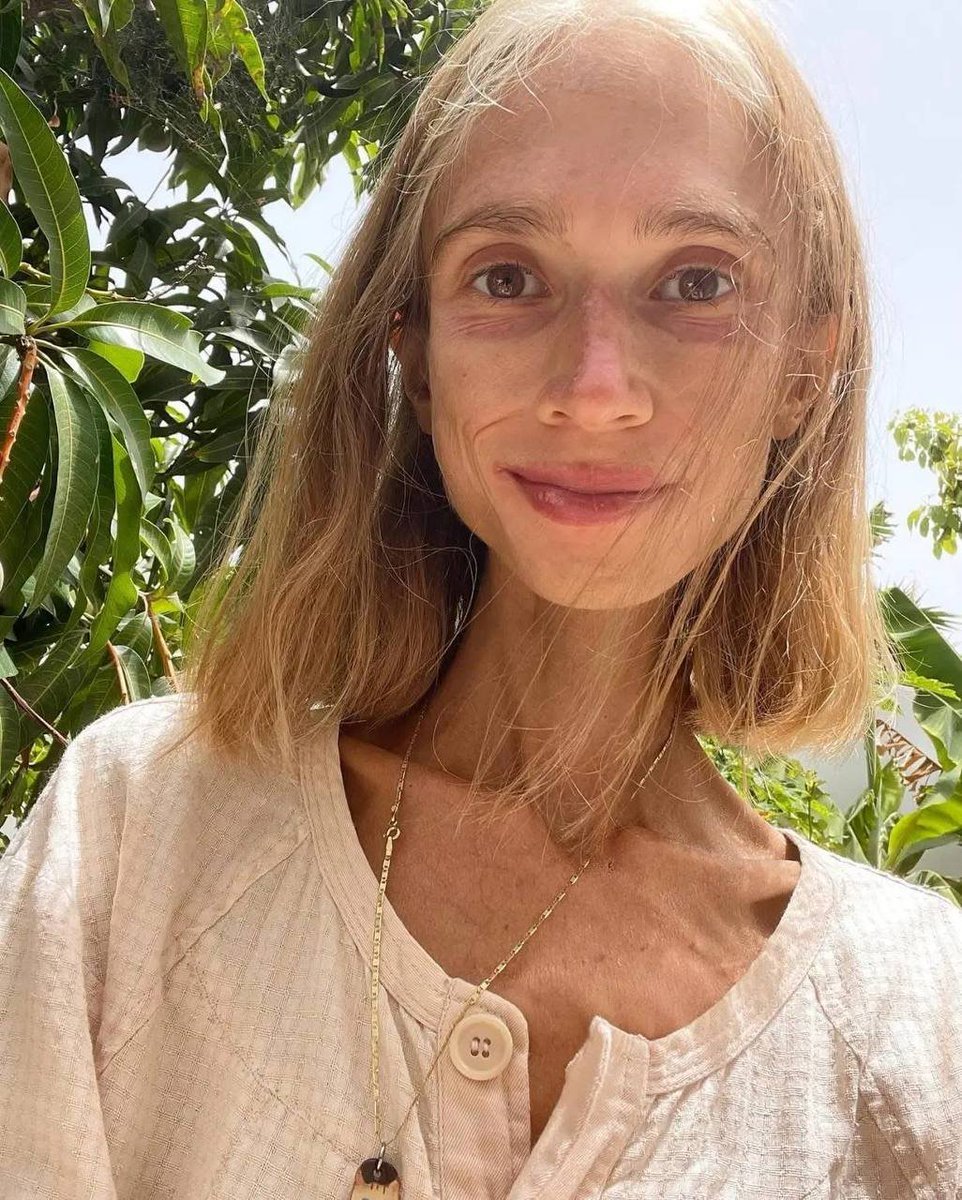 kedrickmutayi's tweet photo. Femme polonaise de 27 ans, elle ne mangeait que des fruits.

Elle en est arrivée à peser 22 kg.
Elle est partie à Bali pour rencontrer son influenceuse bien-être préférée.
Au complexe hôtelier, elle demandait qu’on lui apporte uniquement des fruits.

Elle n’avait même plus la force de se retourner seule dans son lit.
Le troisième jour, on l’a retrouvée effondrée dans sa chambre.

Ongles jaunis, corps détruit de l’intérieur… et ses abonnés lui disaient qu’elle rayonnait et qu’« elle était spirituellement pure ».

Voilà ce qui arrive quand les réseaux sociaux renforcent des idées extrêmes sans que personne ne les arrête.

Ce n’était pas du bien-être. C’était une chambre d’écho aux conséquences bien réelles.