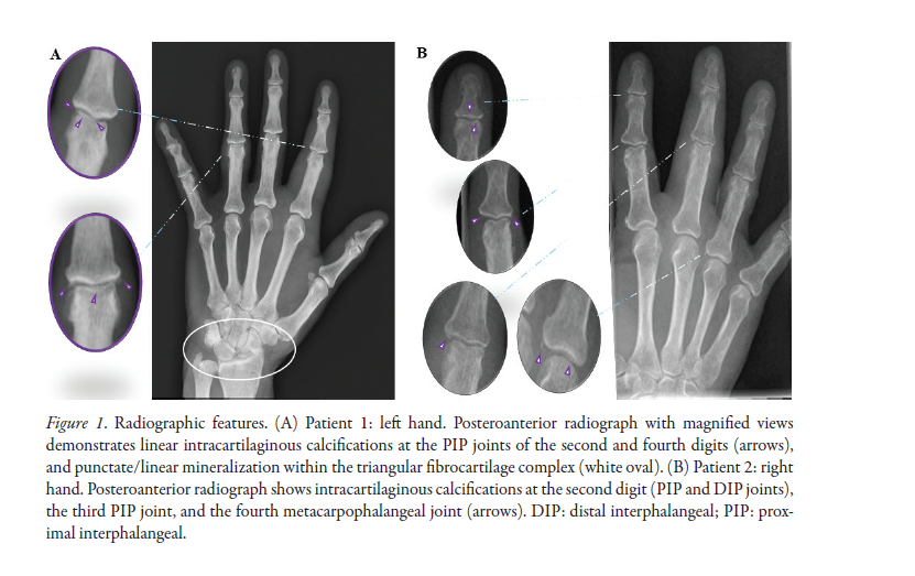 jrheum's tweet photo. Images in Rheumatology
Calcium Pyrophosphate Deposition DiseaseโInduced Acute Dactylitis in the Elderly: A Clinical Ultrasound Mimic
๐ https://t.co/s0l9NhviZz
@AUSLBologna @UninaIT
#CalciumPyrophosphateDepositionDisease #Dactylitis https://t.co/TeMZQkgKD4