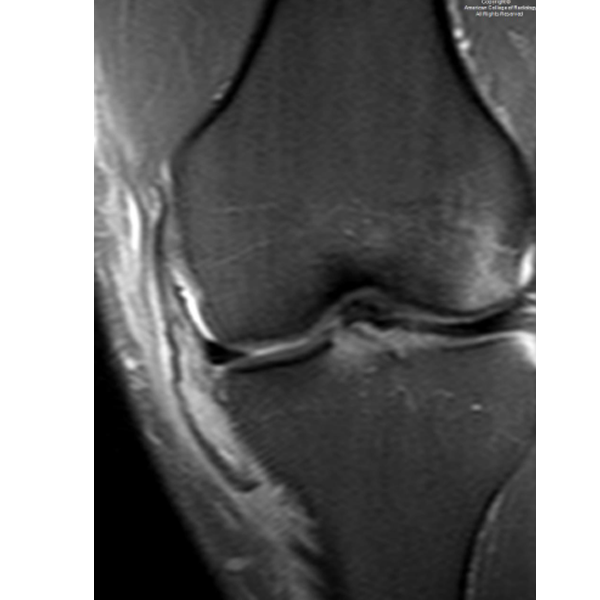 RadiologyACR's tweet photo. A 30-year-old male presents with a valgus stress injury to knee. #ACRCaseinPoint https://t.co/anXt5S1kk0 https://t.co/I5XC7V6m97