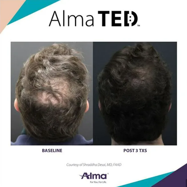 Intuitive_HDPC's tweet photo. Real progress. Real results. ✨

Transform your hair journey with ALMA TED hair restoration treatments at Intuitive Health NC. This non invasive treatment is designed to support healthier, fuller looking hair with no needles and no downtime. Every treatment plan is personalized to help you feel confident every step of the way.

Your results start with consistency, expert care, and a plan made for you.

#thinninghair #thinninghairsolution #thinninghairsolutions #thickenhair #thickenhairnaturally