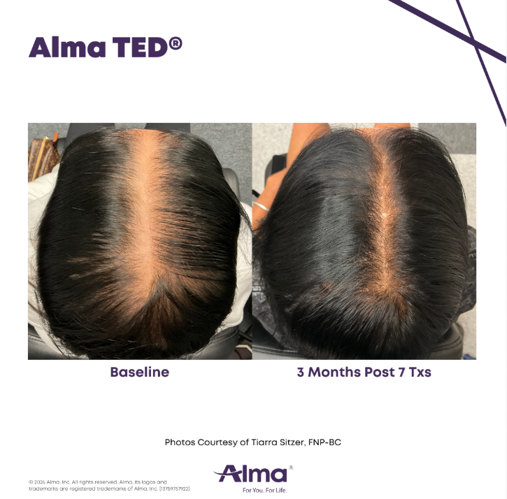 Intuitive_HDPC's tweet photo. Real progress. Real results. ✨

Transform your hair journey with ALMA TED hair restoration treatments at Intuitive Health NC. This non invasive treatment is designed to support healthier, fuller looking hair with no needles and no downtime. Every treatment plan is personalized to help you feel confident every step of the way.

Your results start with consistency, expert care, and a plan made for you.

#thinninghair #thinninghairsolution #thinninghairsolutions #thickenhair #thickenhairnaturally