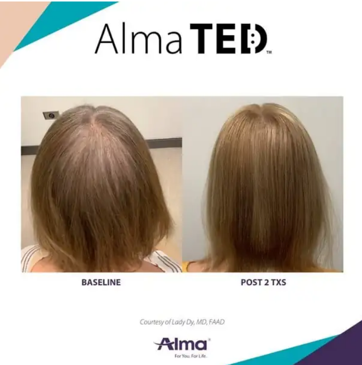 Intuitive_HDPC's tweet photo. Real progress. Real results. ✨

Transform your hair journey with ALMA TED hair restoration treatments at Intuitive Health NC. This non invasive treatment is designed to support healthier, fuller looking hair with no needles and no downtime. Every treatment plan is personalized to help you feel confident every step of the way.

Your results start with consistency, expert care, and a plan made for you.

#thinninghair #thinninghairsolution #thinninghairsolutions #thickenhair #thickenhairnaturally