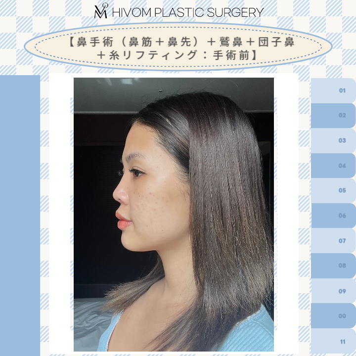 hivompetit's tweet photo. ハイボム美容外科🍑
【鼻手術＋糸リフティング：６か月目】

今なら糸リフティングはイベント中です🥰

手術の症例はこちらから@hivompsJP
お問い合わせはこちらまで♡
ID:@hivom/ 🔗https://t.co/hPTju0SPm3 https://t.co/X2HMcJqHlC