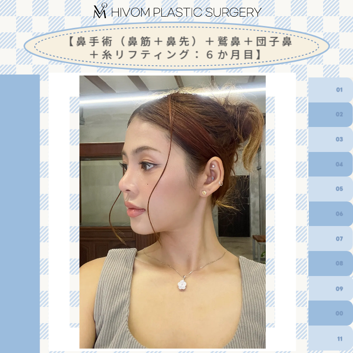 hivompetit's tweet photo. ハイボム美容外科🍑
【鼻手術＋糸リフティング：６か月目】

今なら糸リフティングはイベント中です🥰

手術の症例はこちらから@hivompsJP
お問い合わせはこちらまで♡
ID:@hivom/ 🔗https://t.co/hPTju0SPm3 https://t.co/X2HMcJqHlC