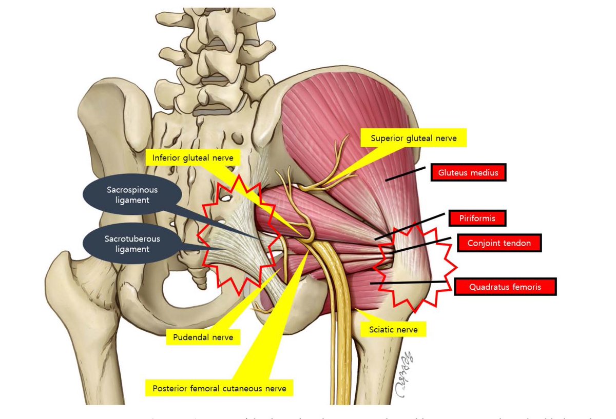 irongrafFT's tweet photo. Deep Gluteal Syndrome: non è solo il nervo sciatico 

https://t.co/WNIo106T4n https://t.co/qnFM5Is2jG