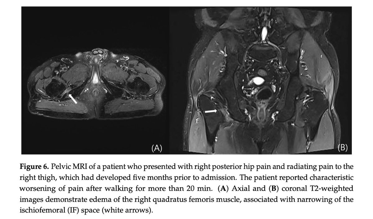 irongrafFT's tweet photo. Deep Gluteal Syndrome: non è solo il nervo sciatico 

https://t.co/WNIo106T4n https://t.co/qnFM5Is2jG