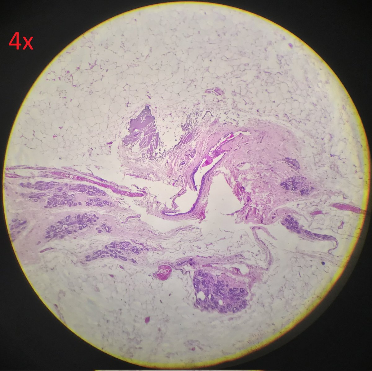 arthy_os's tweet photo. 32/F with an axillary lump for 3 years... excised and sent as 'Lipoma'. Microscopy reveals TDLUs, with lobules of breast tissue and cystically dilated ducts filled with secretions. ACCESSORY (AXILLARY) BREAST https://t.co/IeEROtnXK5