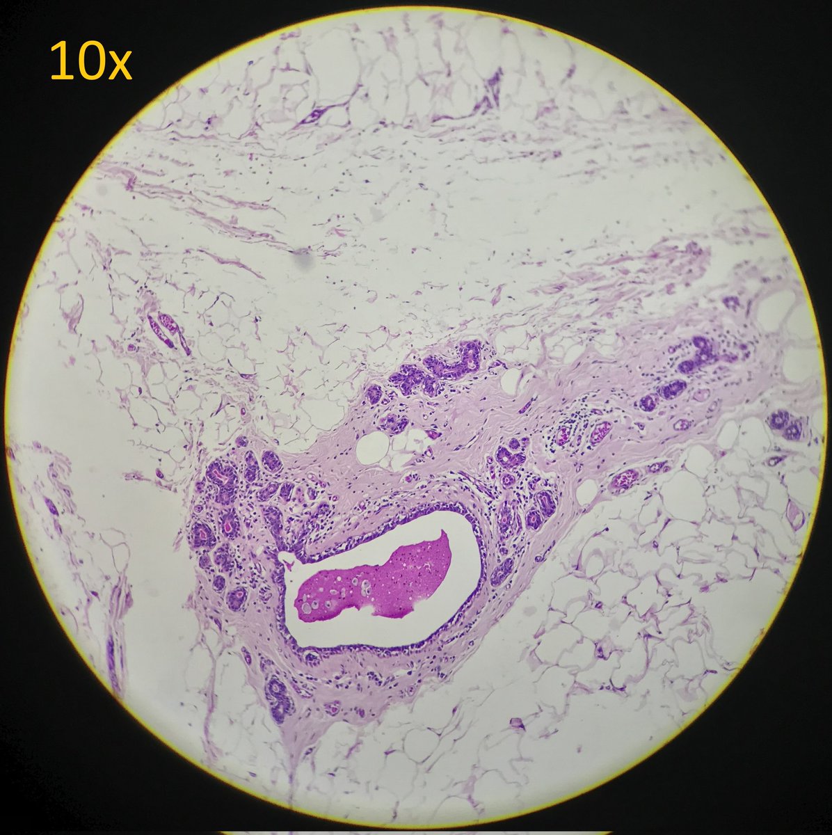 arthy_os's tweet photo. 32/F with an axillary lump for 3 years... excised and sent as 'Lipoma'. Microscopy reveals TDLUs, with lobules of breast tissue and cystically dilated ducts filled with secretions. ACCESSORY (AXILLARY) BREAST https://t.co/IeEROtnXK5