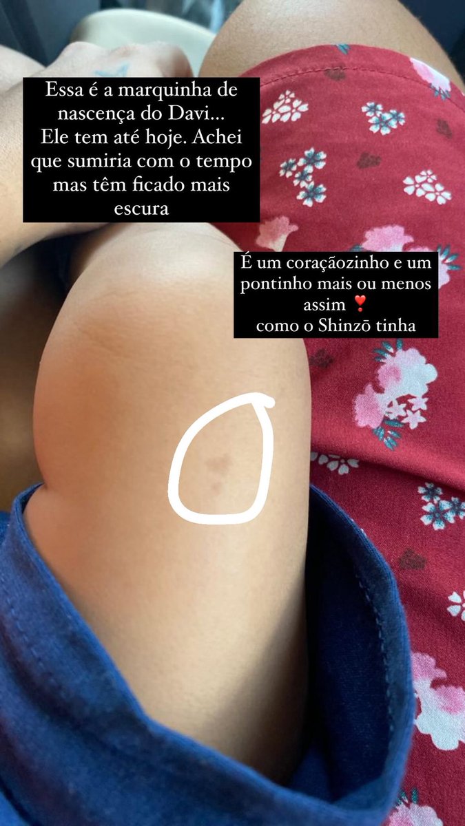 jackbluesSWAG's tweet photo. @1eozinho01 Perdi um gatinho na minha gravidez que chamava Shinzō porque tinha uma marca tipo isso aqui “❣️” um coração c um ponto embaixo. Meu filho tem O MESMO sinal na perna https://t.co/1t0eNvV5QP