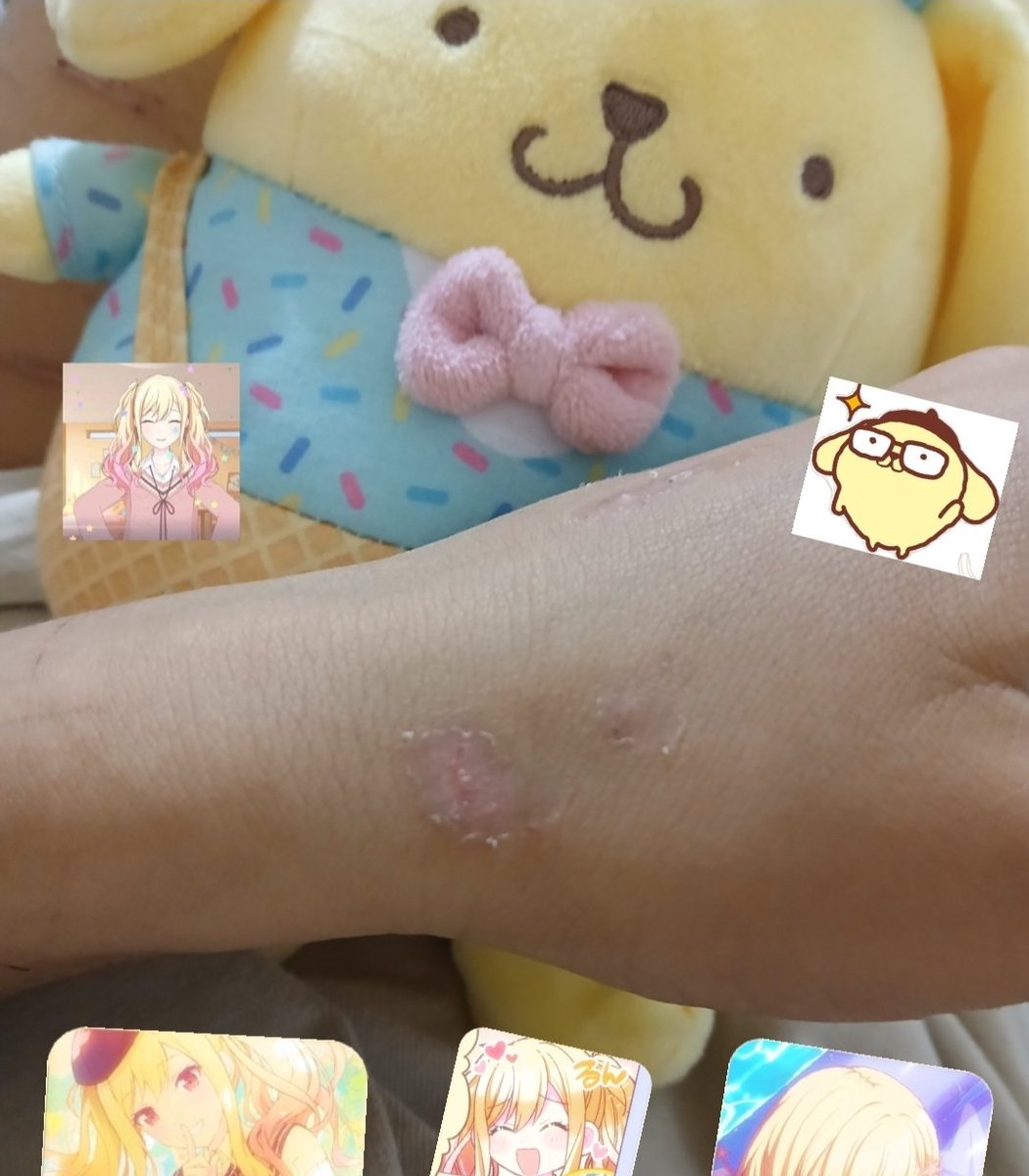 srsytnx28225830's tweet photo. Haiii! :3 took off the scab of my eraser burns (the ones I had on my hand) + healing process of the other eraser burn I did :P
(*≧∀≦) 💗
#shedtwt #shtwt #burntwt https://t.co/Wmzwf39D0v