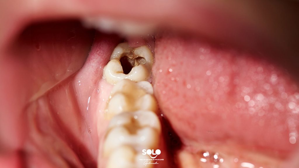 ajansJargon's tweet photo. Diş çürükleriyle ilgili ezber bozan gerçek:

🔷 Diş çürüklerinden tamamen ücretsiz ve diş hekimi müdahalesi gerektirmeyen bir yöntemle korunmak mümkündür.

🔷 Düzenli diş fırçalama, diş ipi kullanımı ve dil temizliğine rağmen çürük oluşumu devam edebilmektedir.

🔷 18.000 kişi üzerinde yapılan yeni bir araştırmada, sadece kandaki D vitamini seviyesinin yükseltilmesiyle diş çürüklerinin %47 oranında azaldığı ispatlanmıştır.

🔷 D vitamini diş minesini korurken, tükürük akışını artırmakta ve tükürükteki antibakteriyel peptitleri desteklemektedir.

🔷 D vitamini eksikliği durumunda tükürük, ağızda çürüğü engelleyen mineralleri tutamamaktadır.

🔷 İlgili araştırmaya göre; şeker tüketimi sıfırlansa ve ağız hijyeni maksimum seviyede tutulsa dahi, D vitamini seviyesi düşük olan kişilerde çürük oranı en yüksek seviyede kalmaktadır.

🔷 Diş sağlığını korumak adına yeterli güneş ışığı almak, uzman hekim kontrolünde D vitamini seviyesini ölçtürmek ve gerekirse takviye kullanmak büyük önem taşımaktadır.