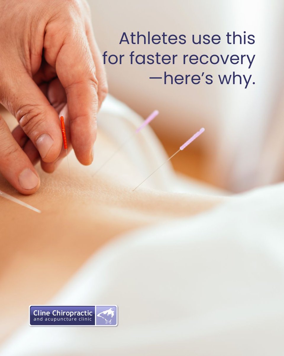DrAdamCline's tweet photo. Acupuncture helps reduce inflammation and improve blood flow, making it a great option for recovery after workouts or injuries. 

At Cline Chiropractic &amp; Acupuncture Clinic in West Lafayette &amp; Lafayette, we customize every treatment based on your needs.

https://t.co/VWm4QkFNdX https://t.co/E84f0fJfmT