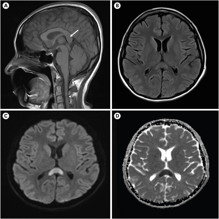 DocNavarrow's tweet photo. 👩‍🔬24-year-old woman with 4 months of progressive behavioral change, paranoid delusions, insomnia, memory impairment, and catatonic features. Fever later developed, prompting brain MRI.

🏥What’s your differential diagnosis? https://t.co/lKFGKRyyRf