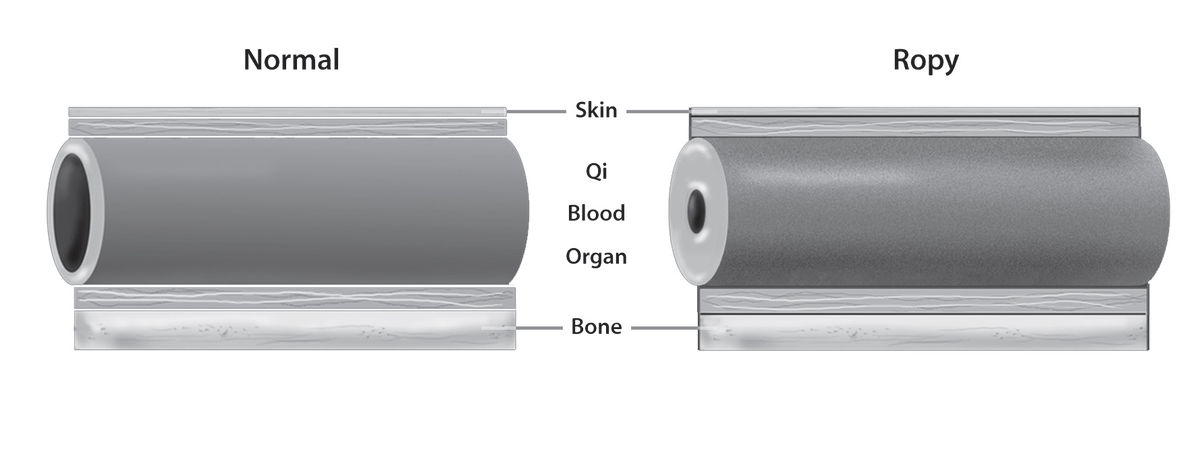 rossrosen's tweet photo. @MidwesternDoc Image below from my book, Heart Shock.  Stagnation creates heat, which if no outlet creates inflammation in vulnerable areas and/or the blood.  This dries out the blood and vessel leading to more viscous blood with less ability to nourish the vessel wall.  Easily felt on pulse. https://t.co/1LVMQh8hpE