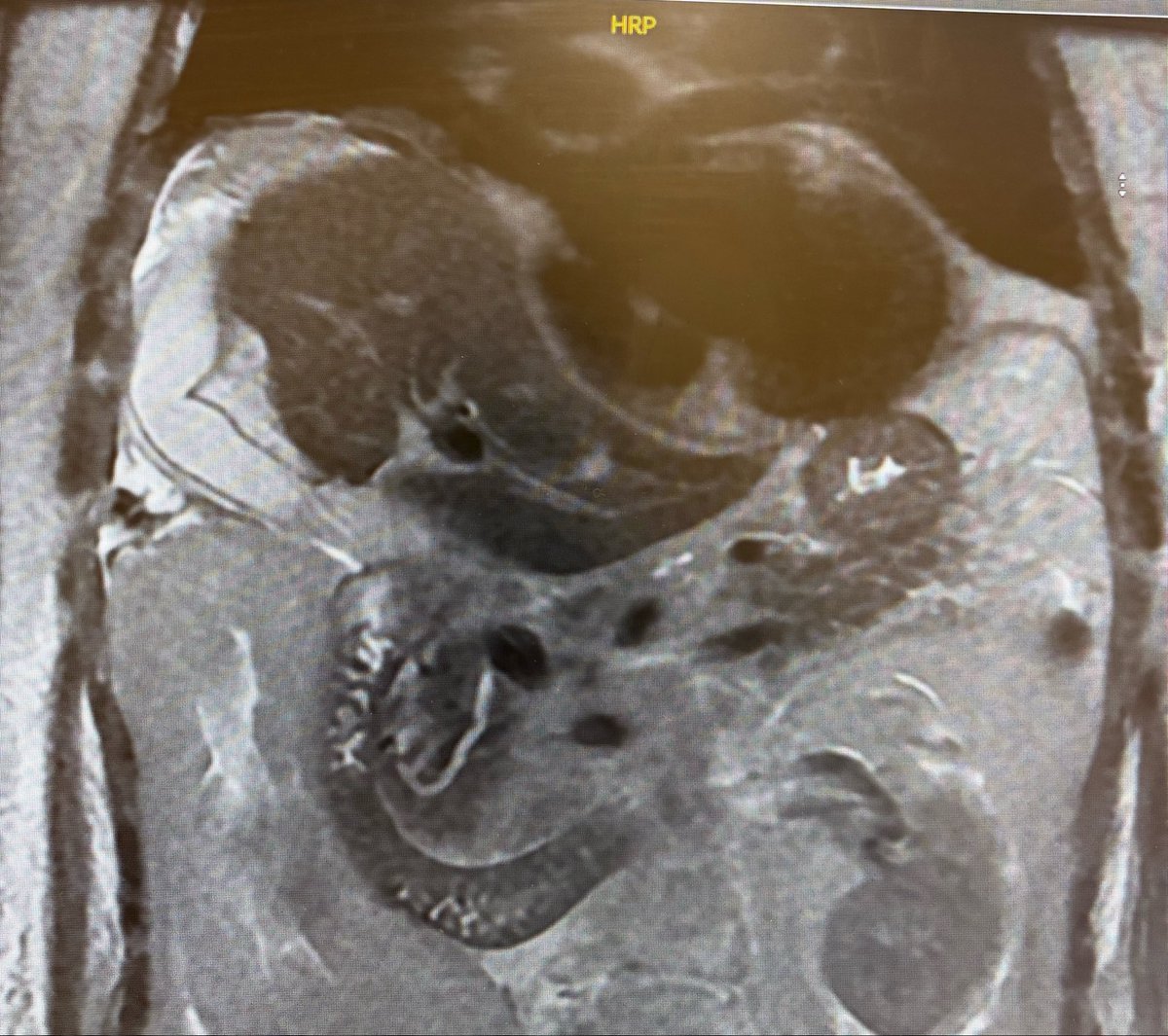 Naif_87's tweet photo. Cholecystitis in an unusually upward-oriented gallbladder in a sub-diaphragmatic location. Not suitable for LAMS GBD. Two stick technique (US transpleural needle for opacification, then fluoroscopy guided access to the GB pouch). Access angle allowed a 6.5 Fr endoscope to clear the neck and fundus.