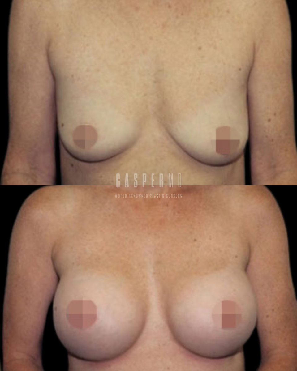 drdanielcasper's tweet photo. A beautifully balanced transformation with enhanced fullness, projection, and upper-pole volume while still maintaining natural proportions. ✨

Ready to explore your options? Schedule your consultation https://t.co/LPOpcWMaNc https://t.co/TvIa6BMsHg