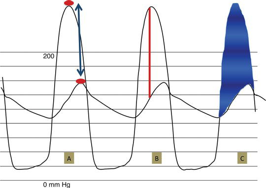 RitikaTuliMD's tweet photo. #CardioNugget™

Cath gradients in AS are not all the same:

Peak-to-peak gradient
Peak LV systolic pressure − peak aortic systolic pressure
The peaks occur at different times → not a true instantaneous gradient
BUT clinically, the peak-to-peak gradient often approximates the mean transaortic gradient.

Peak instantaneous gradient
Closest equivalent to Doppler peak gradient

Mean gradient
The shaded area 
Average of all instantaneous LV–Ao gradients during systole

Clinical pearl:
-Echo/cath mean gradients are most clinically useful
-Peak-to-peak gradient should not be used interchangeably with Doppler peak gradient

#CardioNuggets #MedEd #CardioMed #CardioMed #EchoFirst #AorticStenosis #MeanGradient