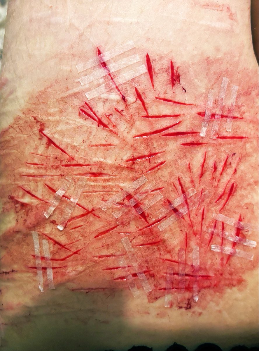 SAlivexx's tweet photo. aftercare final boss 

why is my thigh so fat that it looks like the pig skin tattoo artists practice on 🥹 

SFX MAKEUP NOT REAL. 

#shtwt #stryotwt #notmybest #shedtwt https://t.co/Jxqvn8DkEq