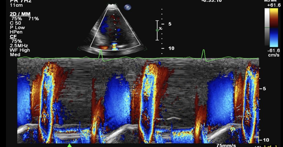 RitikaTuliMD's tweet photo. #CardioNugget™: Diastolic MR 🫀

MR occurs whenever LV pressure > LA pressure

Usually this is during systole — but in:
Complete heart block
Long PR interval
AV dissociation
Severe ↑ LVEDP
…LV pressure briefly exceeds LA pressure in diastole → causing diastolic MR.

Echo clues:
Small low-velocity MR jet
Occurs after A wave
Seen before systole/QRS
Best seen on color M-mode or CW Doppler

Board pearl:
Diastolic MR usually reflects abnormal hemodynamics, not primary MV disease.

#EchoBoards #CardioNuggets #CardioMed #DiatolicMR