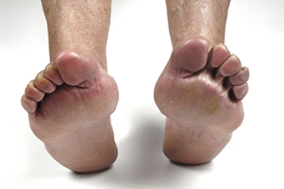 FusionFoot's tweet photo. Living With Foot Pain in Chronic Conditions https://t.co/wtoqLWmH2j https://t.co/yTOxOrMBJn