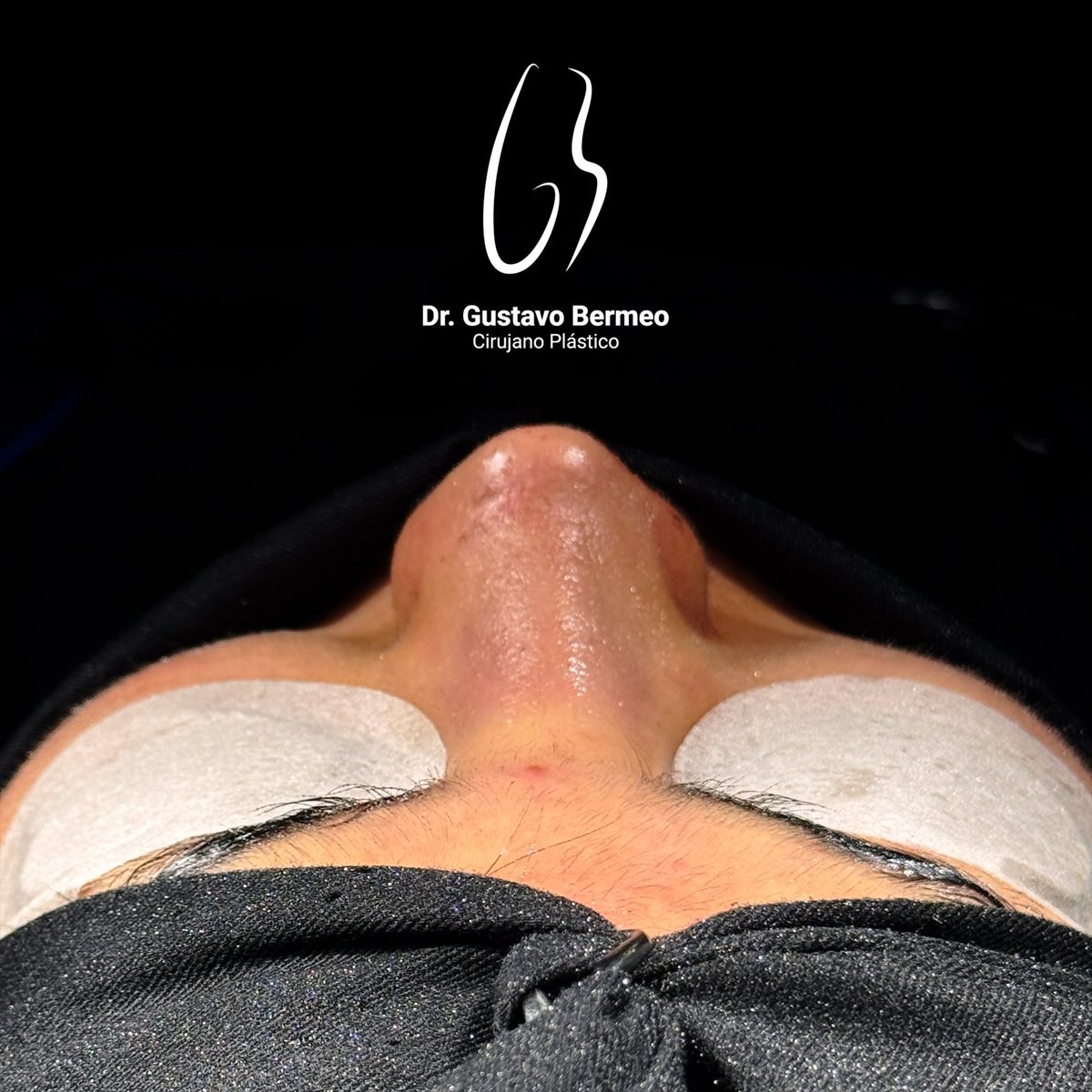 gusber1985's tweet photo. La rinoplastia permite perfeccionar la armonía del rostro con precisión, delicadeza y una visión estética enfocada en resultados elegantes y naturales. https://t.co/1Di5Uhnw7k