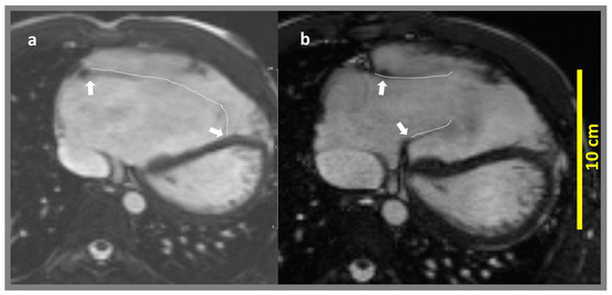 Applsci's tweet photo. #highlycited paper
📚Change in #RightVentricularStrain After Cone Reconstruction of Ebstein’s Anomaly: A Cardiovascular Magnetic Resonance-Feature Tracking Study
🔗https://t.co/CKTnyAoT10
👨🔬by Claudia Furtmüller et al.
@TU_Muenchen
#featuretracking #conerepair https://t.co/vWssGIqXNv