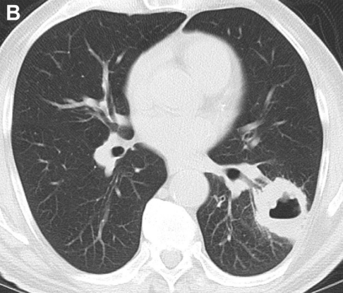 Diegod192's tweet photo. 🫁Enfermedad pulmonar cavitaria🩻

🔵Definición
Espacio lleno de aire que se encuentra dentro de una masa, nódulo o consolidaciones, con paredes bien definidas y que generalmente miden >4 mm.

🔵Clasificación 
Agudo: <12 semanas
Crónico: >12 semanas https://t.co/sn0NefqREZ