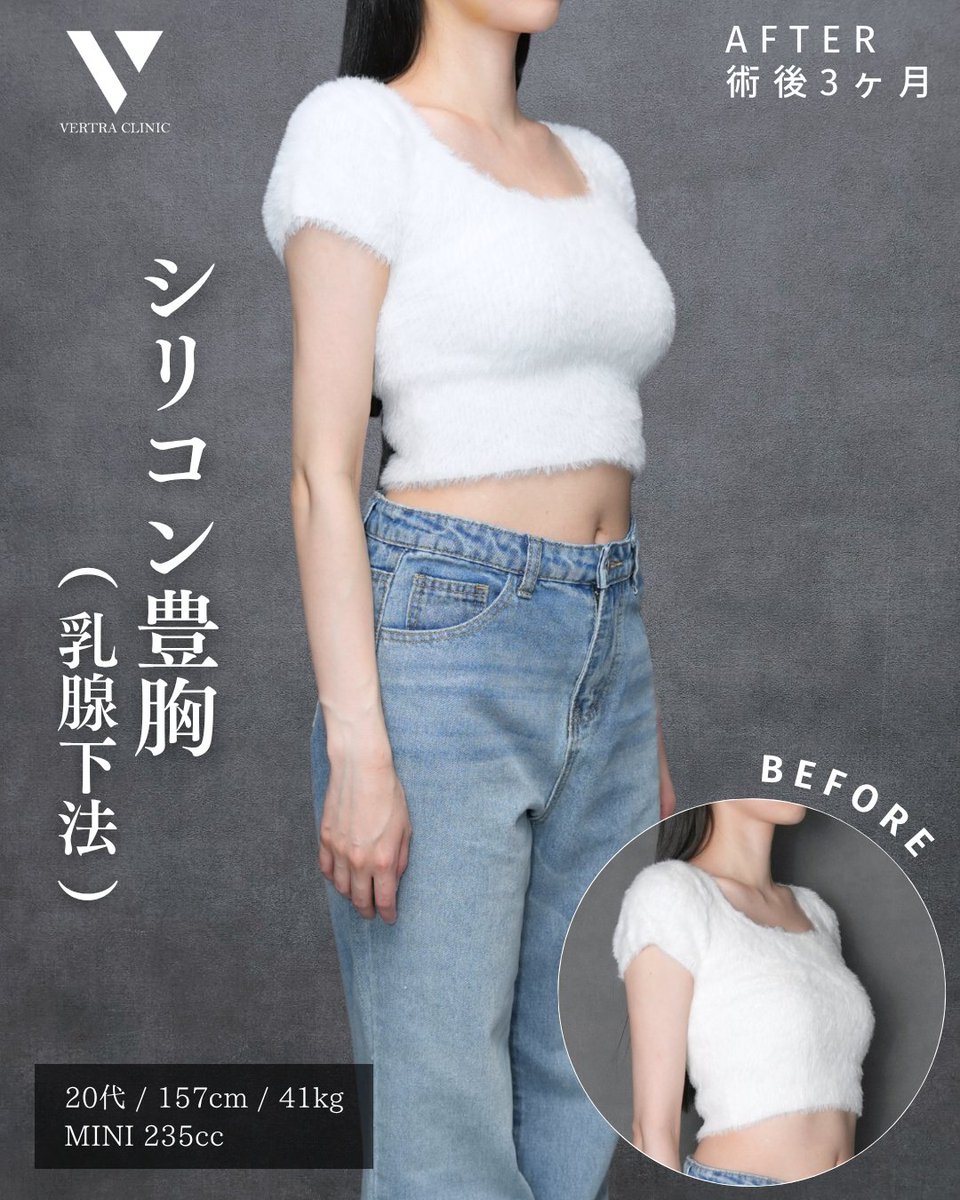 vertraclinic's tweet photo. 《 施術内容 》
シリコン豊胸(乳腺下法)

《 執刀医 》
大阪院院長 河中 聡之(@Dr_kawanaka)

《 詳細 》
女性/20代/157cm/41kg
シリコンバッグ：motiva エルゴノミクス2
シリコンサイズ：MINI 235cc
挿入部位：脇下 https://t.co/hjejsAqCSs