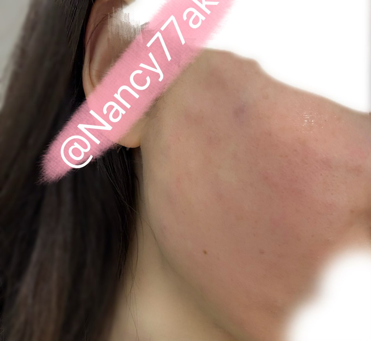 Nancy77ak's tweet photo. ◾️プリアクリニック　江南
無痛リジュラン3cc

麻酔時間も長めにしてくれて
本当耐えれるくらい痛くなかったよ〜！

なぜか肌薄いのに全然エンボス出なかったんだけど...🥲？効果はまた経過で投稿します！

イベントのガチャで洗顔フォーム
術後アザクリーム（黄色）いただけて
盛りだくさんでした❣️ https://t.co/kOYxLiKB69