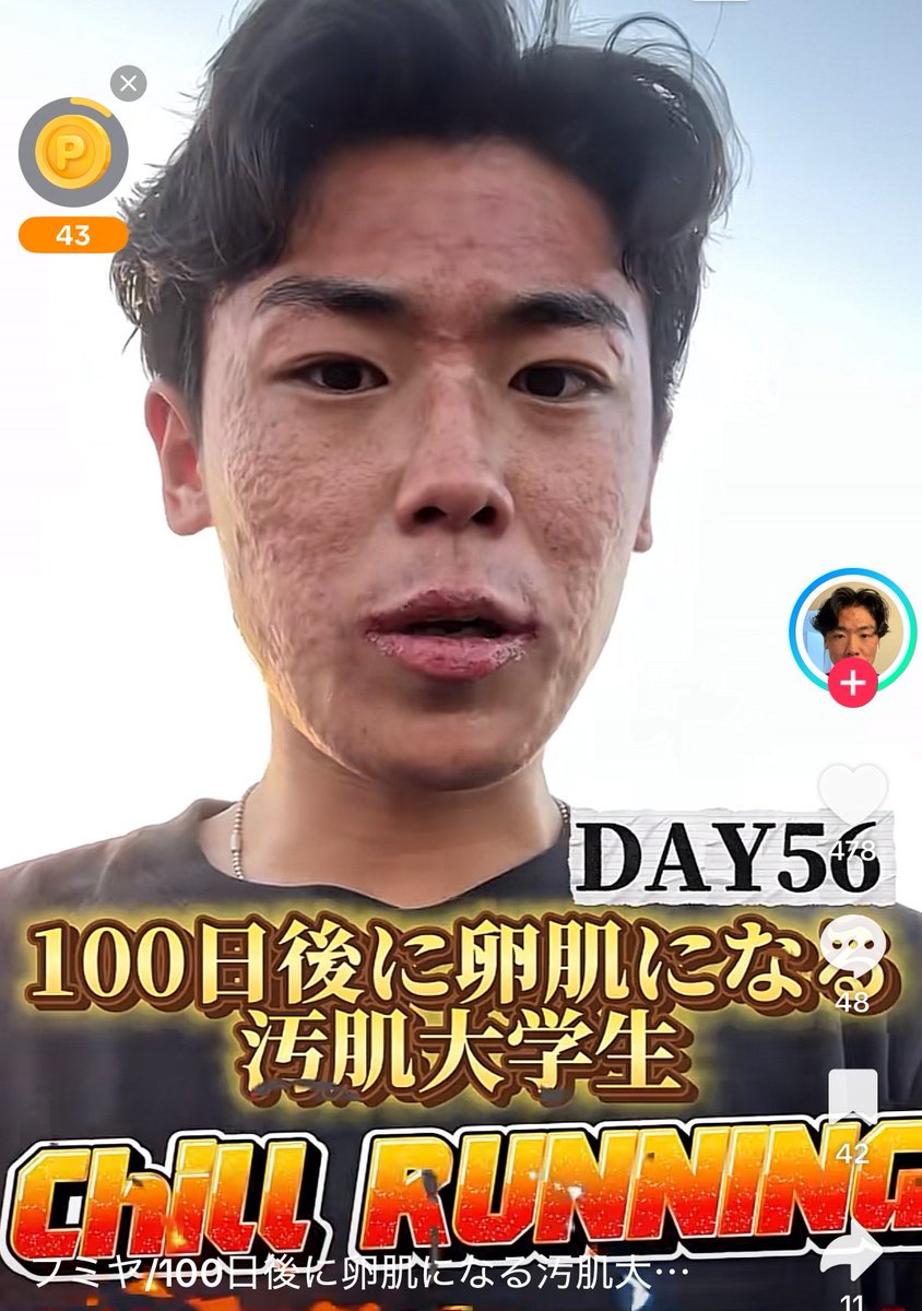 クレーターニキビ治療 tweet media
