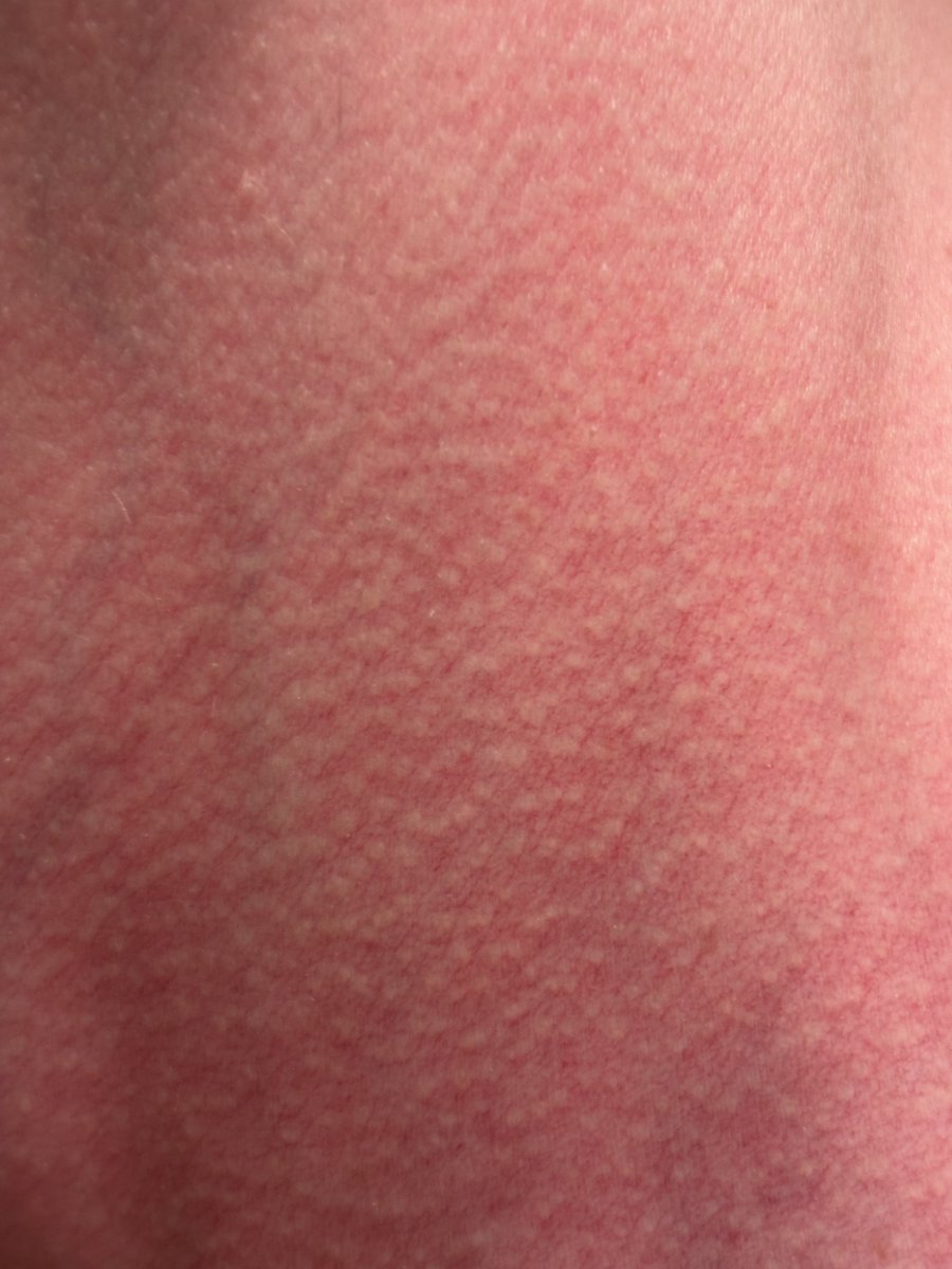 HollowCurrent's tweet photo. @MattZirwas @eurekaskastle @kristyalpert There is also however no hyperpigmentation/brown discolouration. A biopsy showed nothing remarkable https://t.co/Kyc70YWmUu