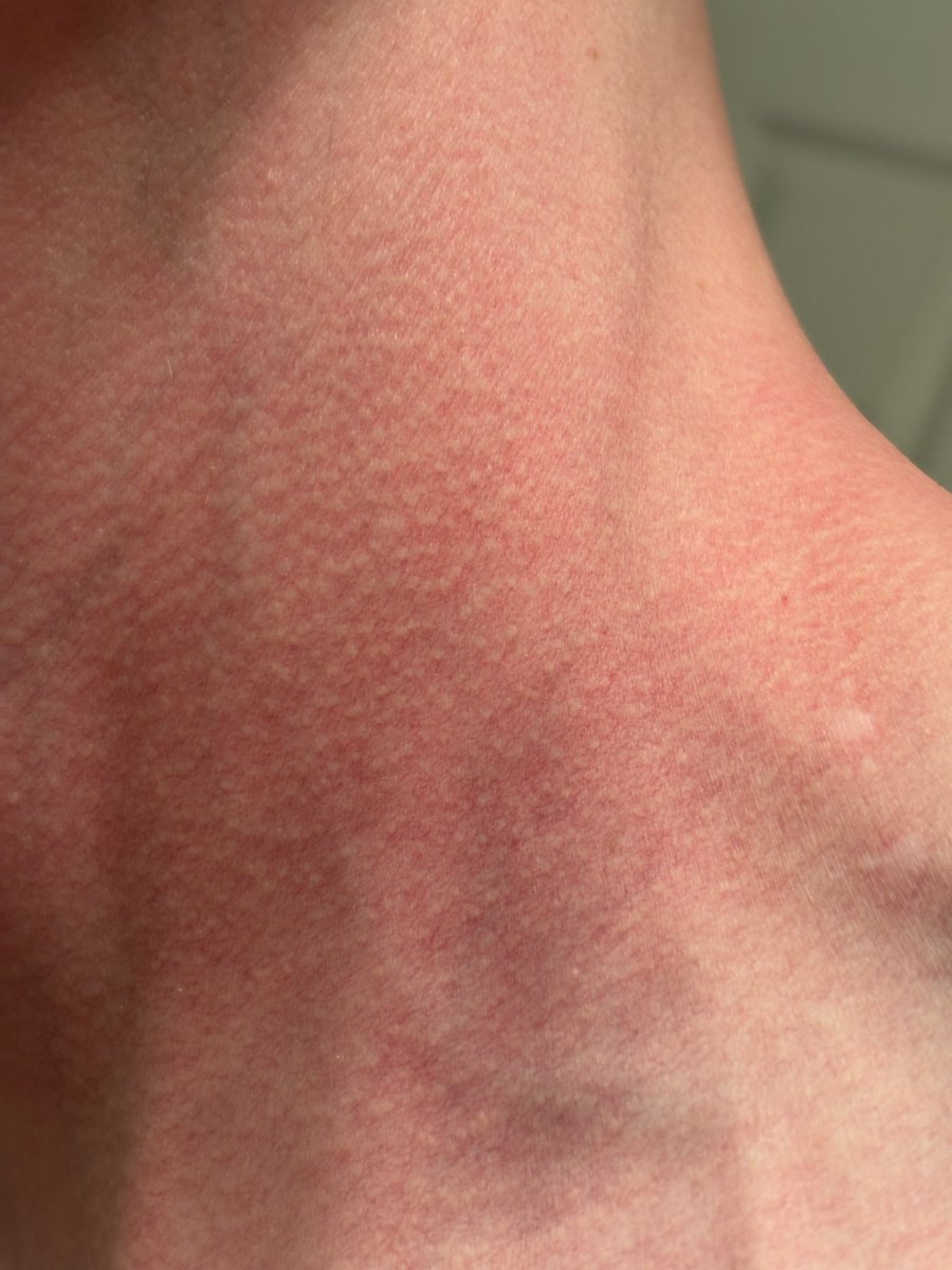 HollowCurrent's tweet photo. @MattZirwas @eurekaskastle @kristyalpert There is also however no hyperpigmentation/brown discolouration. A biopsy showed nothing remarkable https://t.co/Kyc70YWmUu