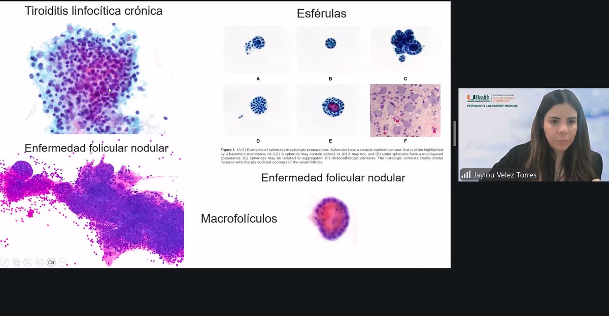 MonicaGarciaBu2's tweet photo. Thyroid cytology session with @JaylouVelez: Bethesda categories, tricky cases, and practical pearls you can use every day🔬🧐 @UMiamiPathology @CarmenGomezMD @MerceJorda1 @martin_poveda82 @MI_FUCS #tiroides #thyroid @DePatologos @asocolpat @LatinAmericanPF #residents #path https://t.co/UoBiTxqwoX