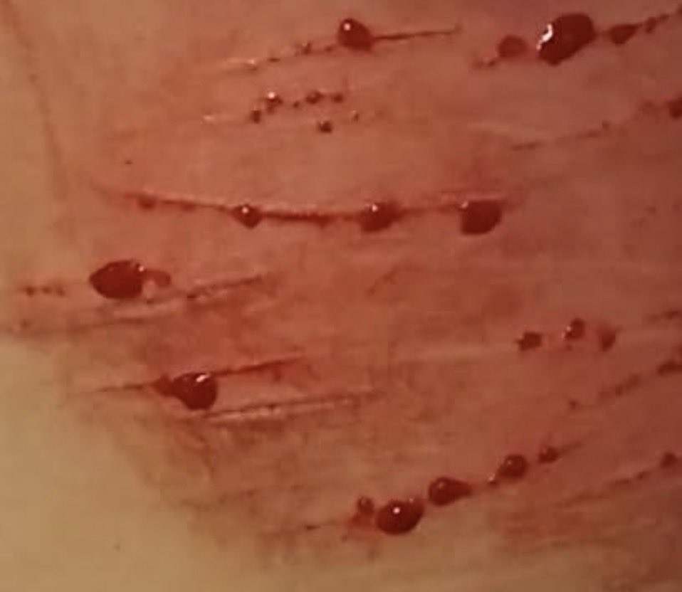 emilyclassof09's tweet photo. Old small cuts from last yr!
#shtwt #shedtwt 
⣰⡿⠿⠿⣷⣦⣠⣤⣾⠟⠛⠳⣦
⡏⢀⢀⣠⣶⠟⣹⣿⠷⣦⡀⢀⢘⡇
⢣⣤⣴⠿⠃⢀⡿⢿⡆⠈⠻⠿⠟⠁
⠀⠀ ⠀⠀ ⣠⠃⠈⠳⡄
⠀⠀  ⣰⡟⠁ ⠀⠀   ⣸
⠀⠀⢰⡏ ⠀⠀⠀  ⢠⡟
⠀⠀⠘⣇ ⠀⠀⠀ ⢸⡇
⠀⠀  ⢿ ⠀⠀⠀⠀⠈⢷⡀ https://t.co/Zn5a7pLesx
