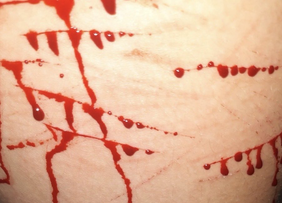 emilyclassof09's tweet photo. Old small cuts from last yr!
#shtwt #shedtwt 
⣰⡿⠿⠿⣷⣦⣠⣤⣾⠟⠛⠳⣦
⡏⢀⢀⣠⣶⠟⣹⣿⠷⣦⡀⢀⢘⡇
⢣⣤⣴⠿⠃⢀⡿⢿⡆⠈⠻⠿⠟⠁
⠀⠀ ⠀⠀ ⣠⠃⠈⠳⡄
⠀⠀  ⣰⡟⠁ ⠀⠀   ⣸
⠀⠀⢰⡏ ⠀⠀⠀  ⢠⡟
⠀⠀⠘⣇ ⠀⠀⠀ ⢸⡇
⠀⠀  ⢿ ⠀⠀⠀⠀⠈⢷⡀ https://t.co/Zn5a7pLesx