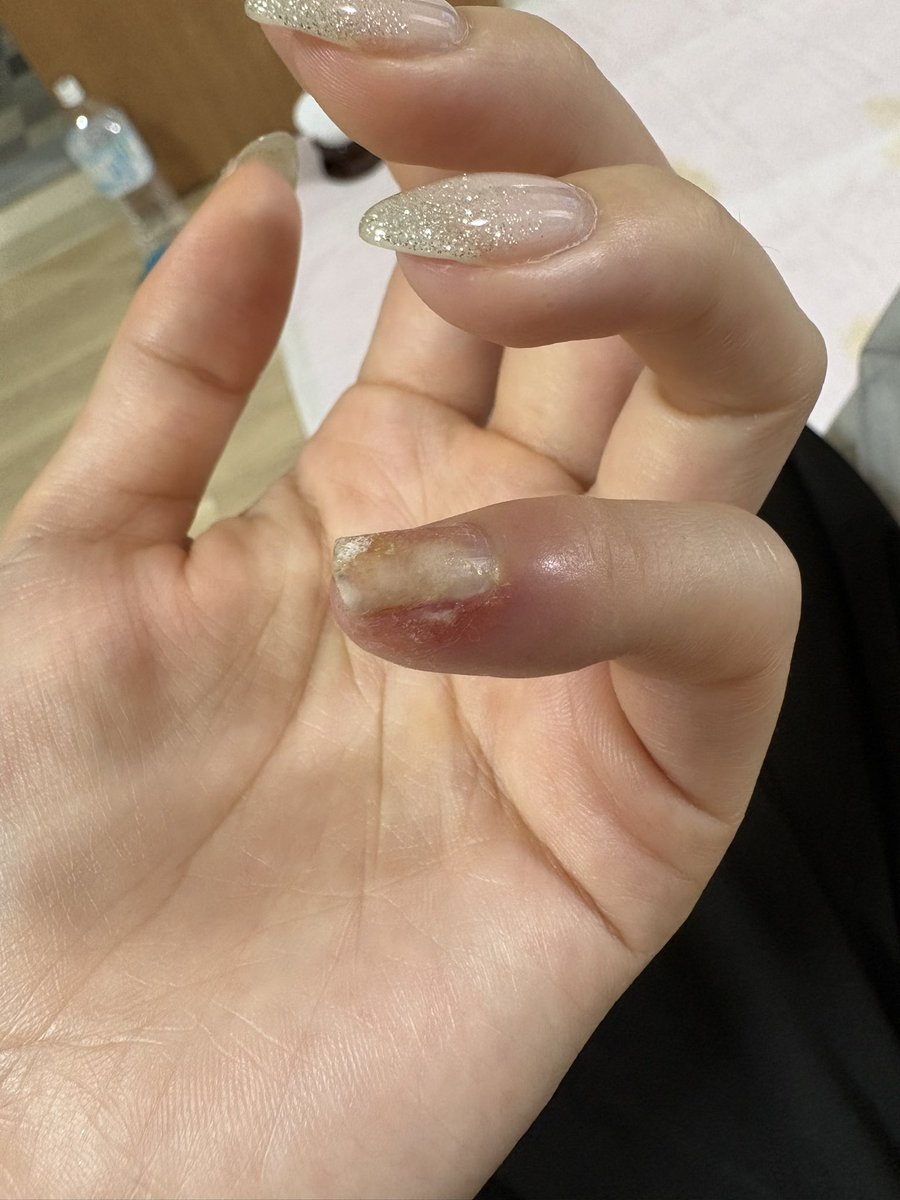 _chun22's tweet photo. 爪が大変なことに。

もう白い部分は浮いてます。

���院きてるけど、
これは皮膚科ではないよな、
親には皮膚科行け言われたけど
内科外科よな https://t.co/GDswu8FX3u