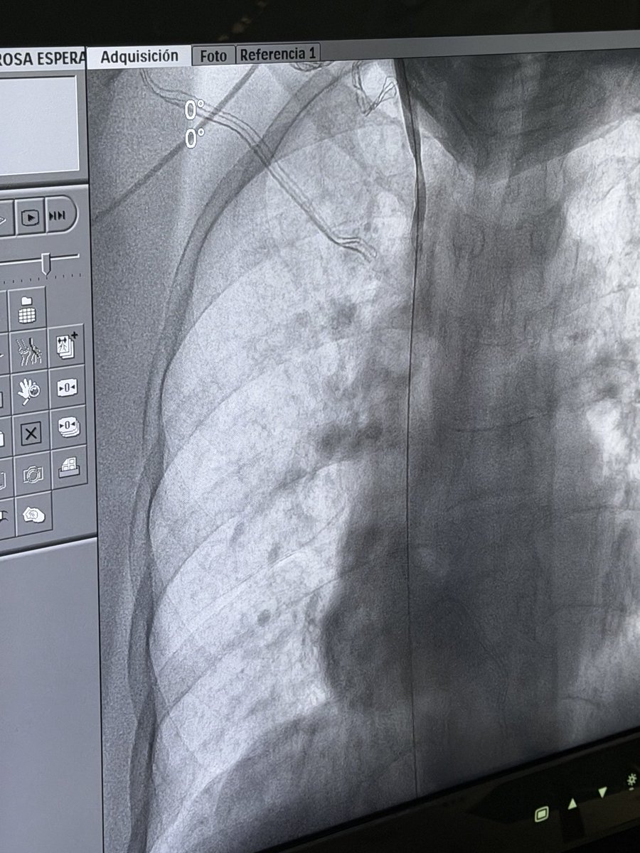 ngm2503's tweet photo. La angioplastia permite al nefrólogo recuperar accesos vasculares o corregir complicaciones de los mismos. Un gusto trabajar con amigos y agradecido por la confianza. Nefro Intervención @Omar_SnchezV @Alexgr23 @IntervenNephMx @nefrointerpocus @sengndi @ISNkidneycare https://t.co/KbpQ3Fsu9W