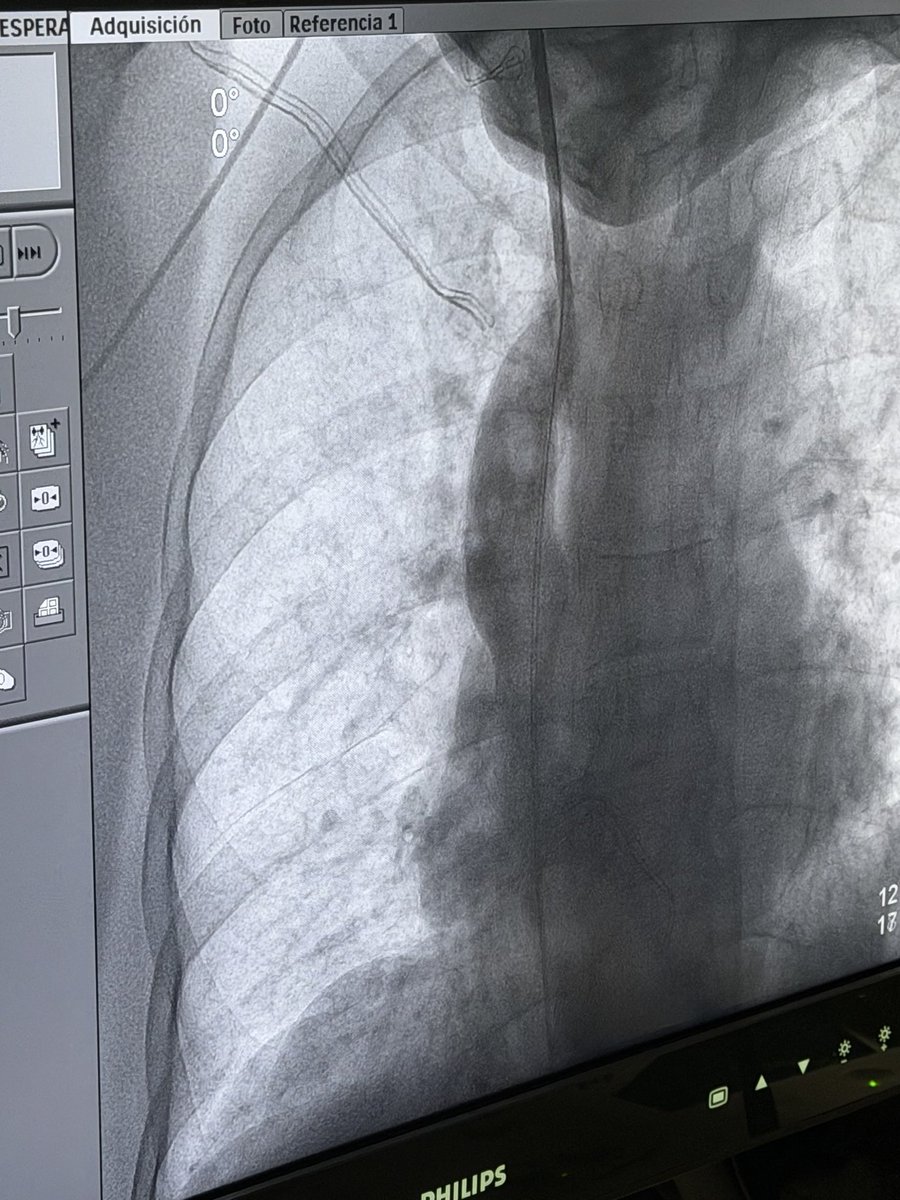 ngm2503's tweet photo. La angioplastia permite al nefrólogo recuperar accesos vasculares o corregir complicaciones de los mismos. Un gusto trabajar con amigos y agradecido por la confianza. Nefro Intervención @Omar_SnchezV @Alexgr23 @IntervenNephMx @nefrointerpocus @sengndi @ISNkidneycare https://t.co/KbpQ3Fsu9W