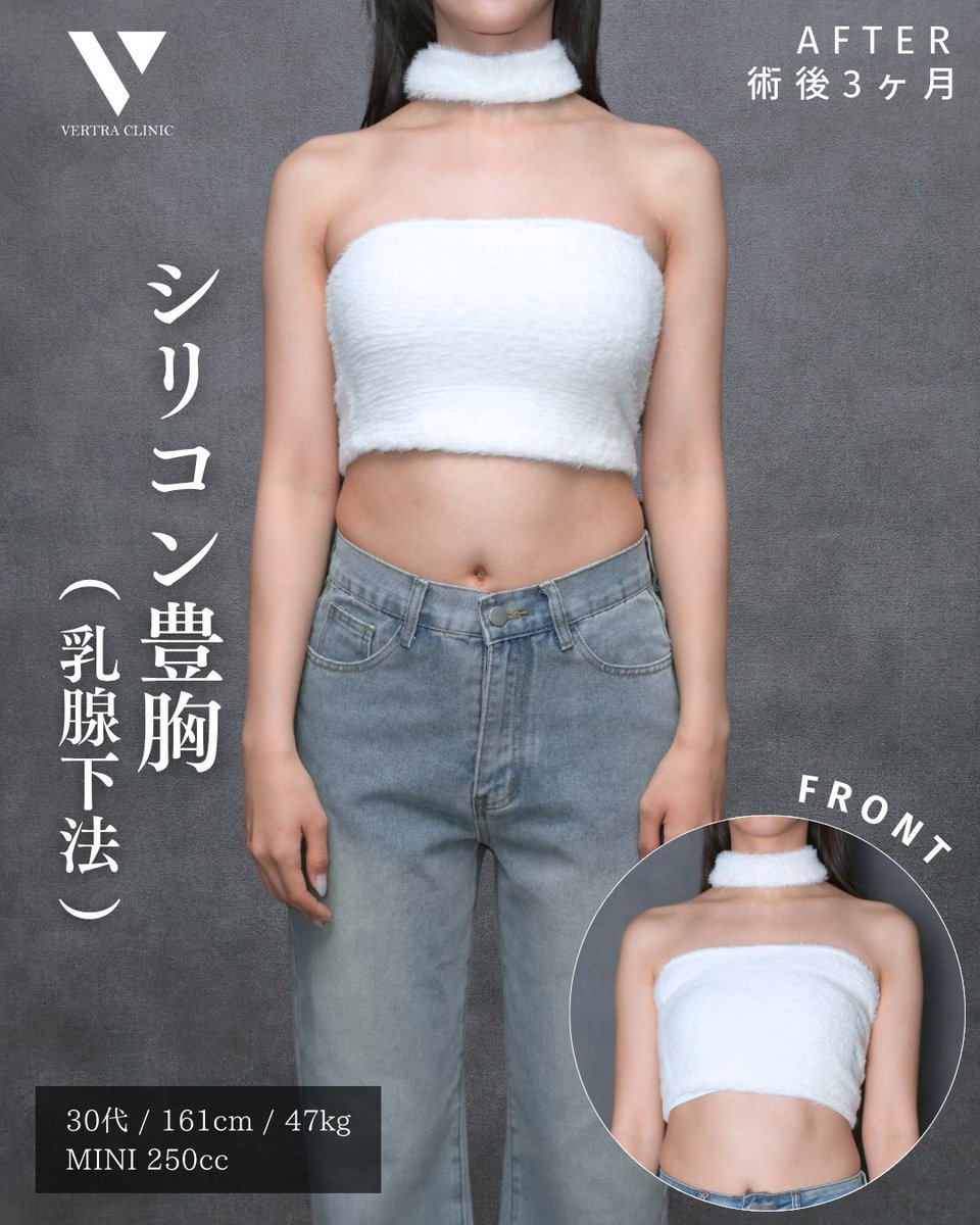 vertraclinic's tweet photo. 《 施術内容 》    
シリコン豊胸(乳腺下法)        

《 執刀医 》    
大阪院院長 河中 聡之(@Dr_kawanaka)       

 《 詳細 》    
男性/30代/161cm/47kg    
シリコンバッグ：motiva エルゴノミクス2    
シリコンサイズ：MINI 250cc    
挿入部位：脇下 https://t.co/3YLaf1cuFn