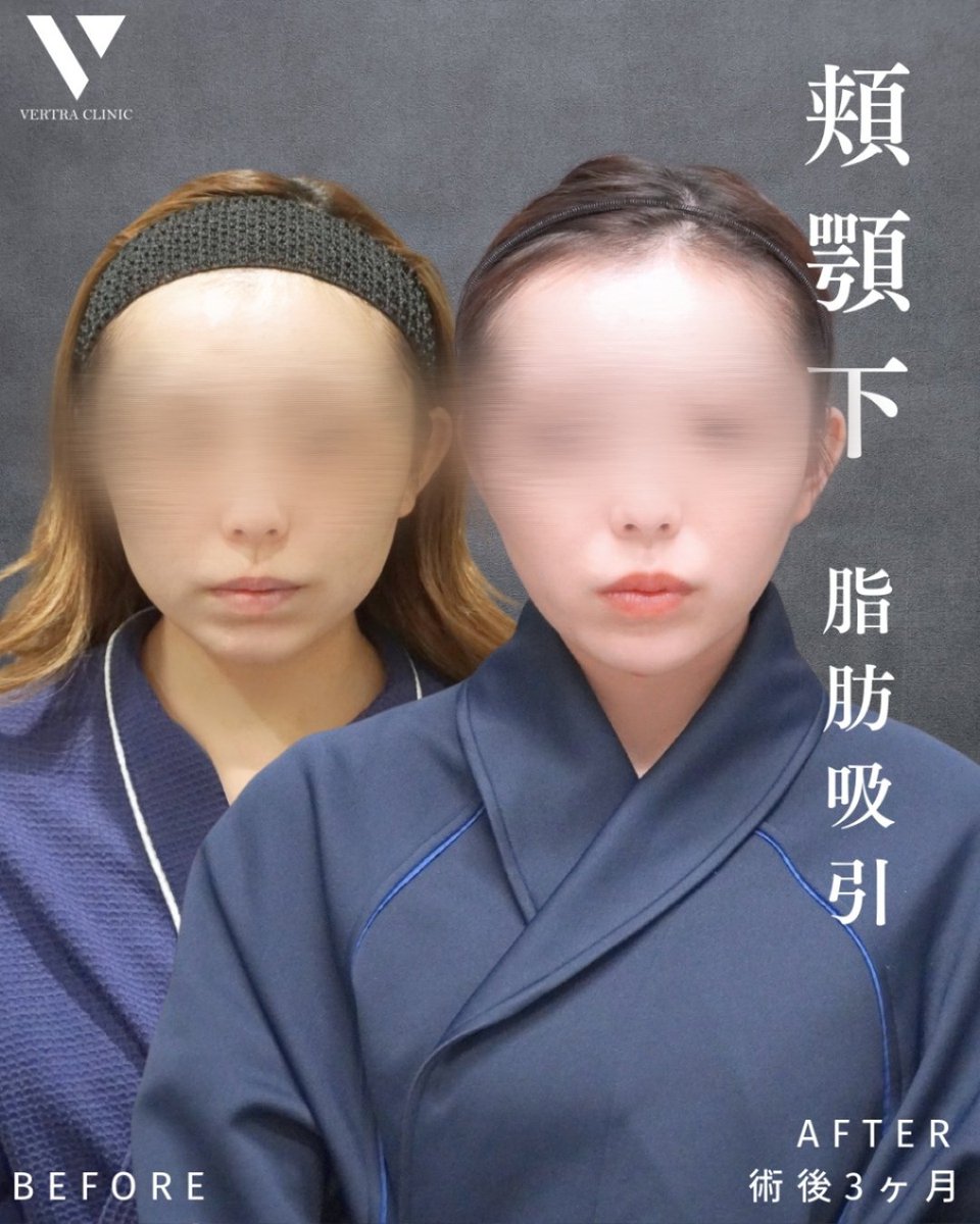 vertraclinic's tweet photo. 《 施術内容 》  
お顔の脂肪吸引＋糸リフト  
吸引部位 ：頬・顎下    

《 執刀医 》  
大阪院院長 河中 聡之(@Dr_kawanaka)    

《 詳細 》 
 女性/20代/163cm/47kg https://t.co/M5NpJS7Vw9