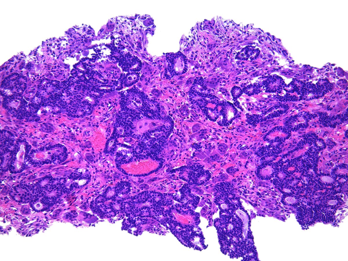 Patholwalker's tweet photo. Invasive cribriform carcinoma of breast. #Pathology #Pathologist #BreastPath https://t.co/layczPrZGd