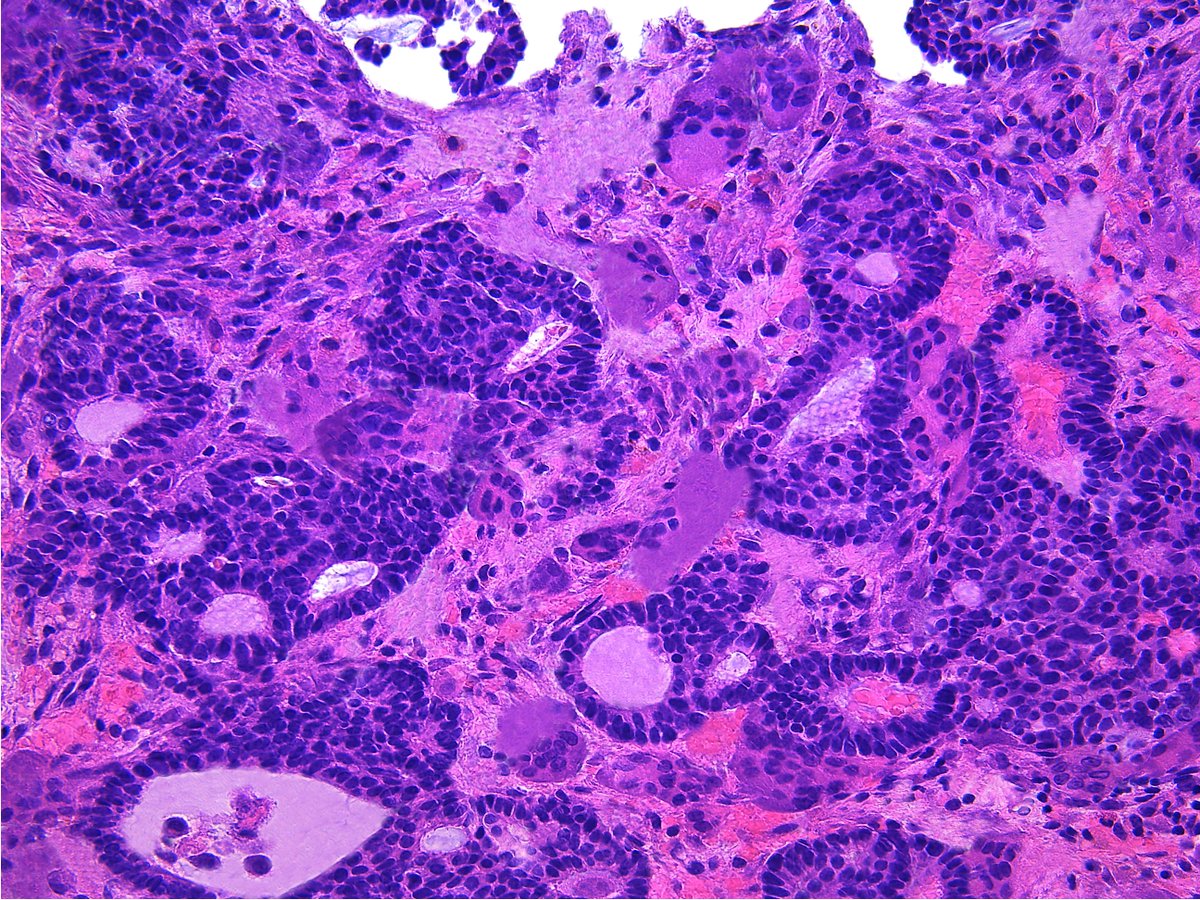 Patholwalker's tweet photo. Invasive cribriform carcinoma of breast. #Pathology #Pathologist #BreastPath https://t.co/layczPrZGd