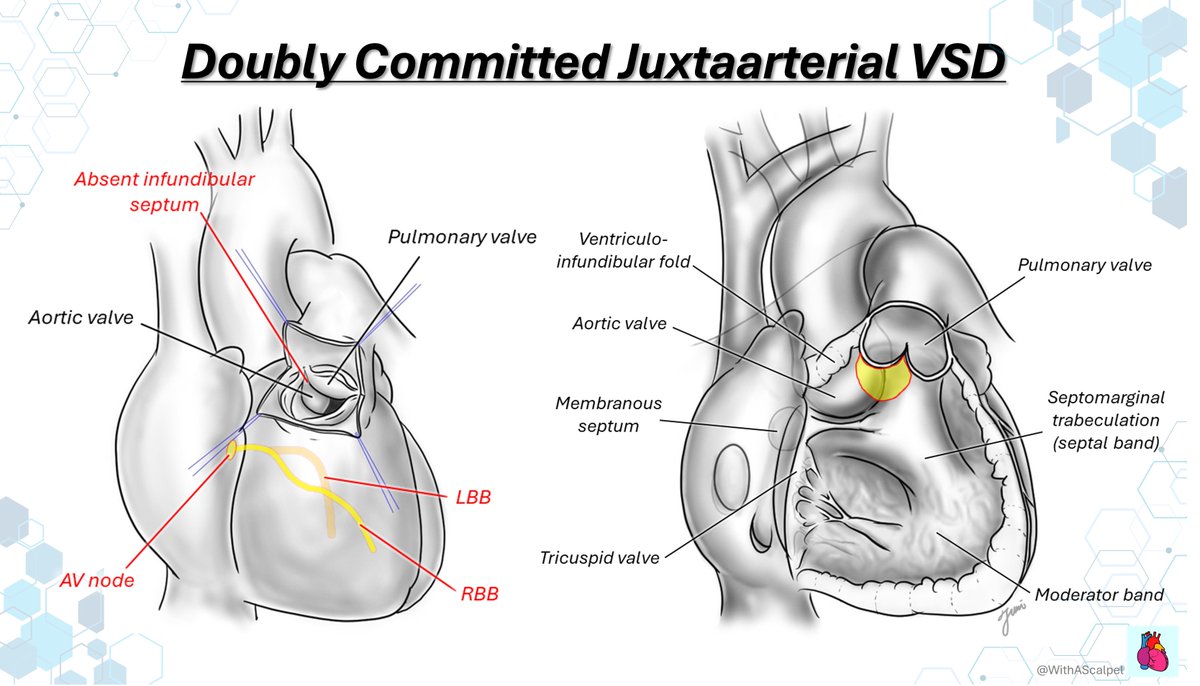 WithAScalpel's tweet photo. DCJA VSD — Aortic Cusp Support Matters🫸

👉In doubly committed juxtaarterial VSD, the absent infundibular septum places the aortic and pulmonary valves in fibrous continuity.
👉Loss of subarterial support can allow RCC prolapse into the defect, especially under the LV-to-RV systolic jet.
👉VSD closure is not only septal repair — it also protects aortic valve geometry and prevents progressive AR.

@RitikaTuliMD
#MedEd #VSD #CardioMed #CongenitalHeartDisease https://t.co/dVfGMBmSi3