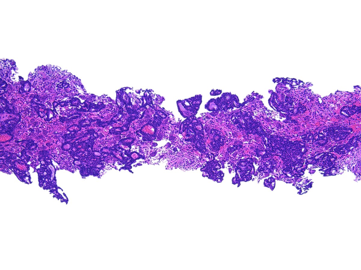 Patholwalker's tweet photo. Invasive cribriform carcinoma of breast. #Pathology #Pathologist #BreastPath https://t.co/layczPrZGd
