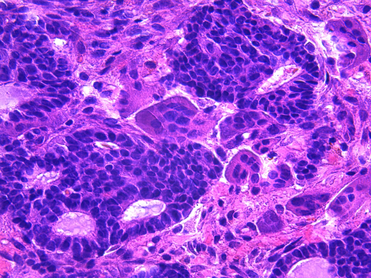Patholwalker's tweet photo. Invasive cribriform carcinoma of breast. #Pathology #Pathologist #BreastPath https://t.co/layczPrZGd