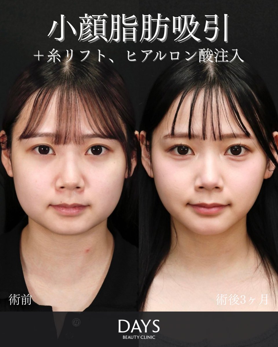 小顔整形 山野祐 tweet media