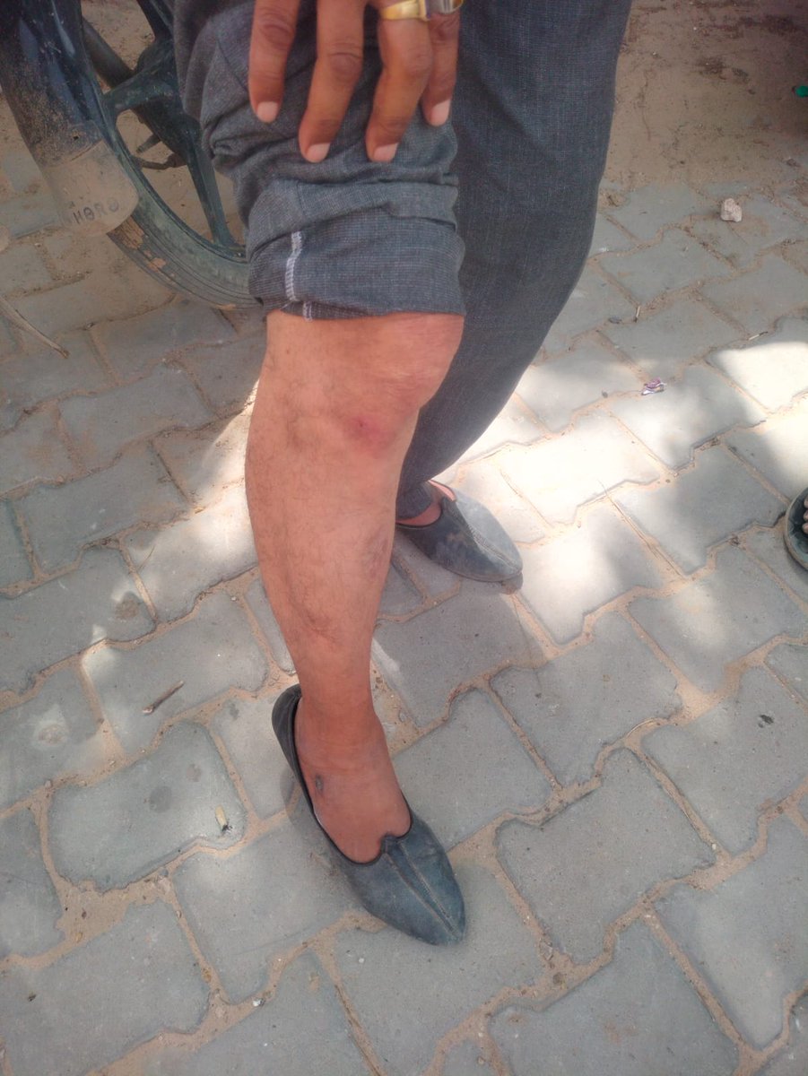 amarkhorwal's tweet photo. 💔 When Seeking Justice Starts Feeling Like Fear

My senior citizen father was abused and physically assaulted by four people on the road. Like any ordinary family, my father and some villagers went to the police station to file a complaint and seek legal protection. During the inquiry, the SHO brought my father back to the village, and one accused person was taken into custody while another reportedly went to the house of a former village sarpanch. The police team also went there, and my father remained sitting inside the police vehicle for a long time during the process.

After returning to the police station, my father and family members kept waiting, but we felt no clear or urgent action was being taken. Feeling helpless and worried for my family’s safety, I posted a tweet requesting authorities to take action.

After this, the situation became even more painful for our family. My father, my uncle, and my uncle’s son were allegedly made to remove their clothes inside the police station, which caused deep humiliation and mental trauma to our family. My uncle’s son was also allegedly beaten despite not being involved in the original assault incident and only accompanying the family for support.

Later, through another person’s phone, I allegedly received pressure to delete my tweet. My father also requested me to remove it because he felt deeply humiliated and feared the situation was becoming worse. Out of fear and concern for my family, I deleted the tweet.

Despite my father being the victim of the assault, preventive action under Section 151 was later imposed on my father, my uncle, and my uncle’s son, and they had to return home on bail instead of feeling protected by the system they approached for help.

Today, my family is emotionally shattered and afraid. I respectfully request the authorities to ensure that no unfair or retaliatory action is taken against my family in the future. I also respectfully request that the CCTV footage of the police station be examined so that the truth of what happened inside can be fairly verified.

I request senior authorities, including @Didwanapolice, @PoliceRajasthan, @Rajeev_ips, @India_NHRC, @HMOIndia, @ANI, @PTI_News, @RajPoliceHelp, @RajCMO, and @ndtvindia, to kindly look into this matter and ensure accountability, fairness, and protection for ordinary citizens. I also request reassurance that my family will remain safe and free from fear or harassment.

Law should create fear in criminals, not fear in ordinary citizens who come seeking justice and dignity.

If this reaches you, please read and share. Today it is my family’s story. Tomorrow it could be any ordinary family in India.

#Justice
#HumanRights
#SeniorCitizenSafety
#PoliceAccountability
#Rajasthan