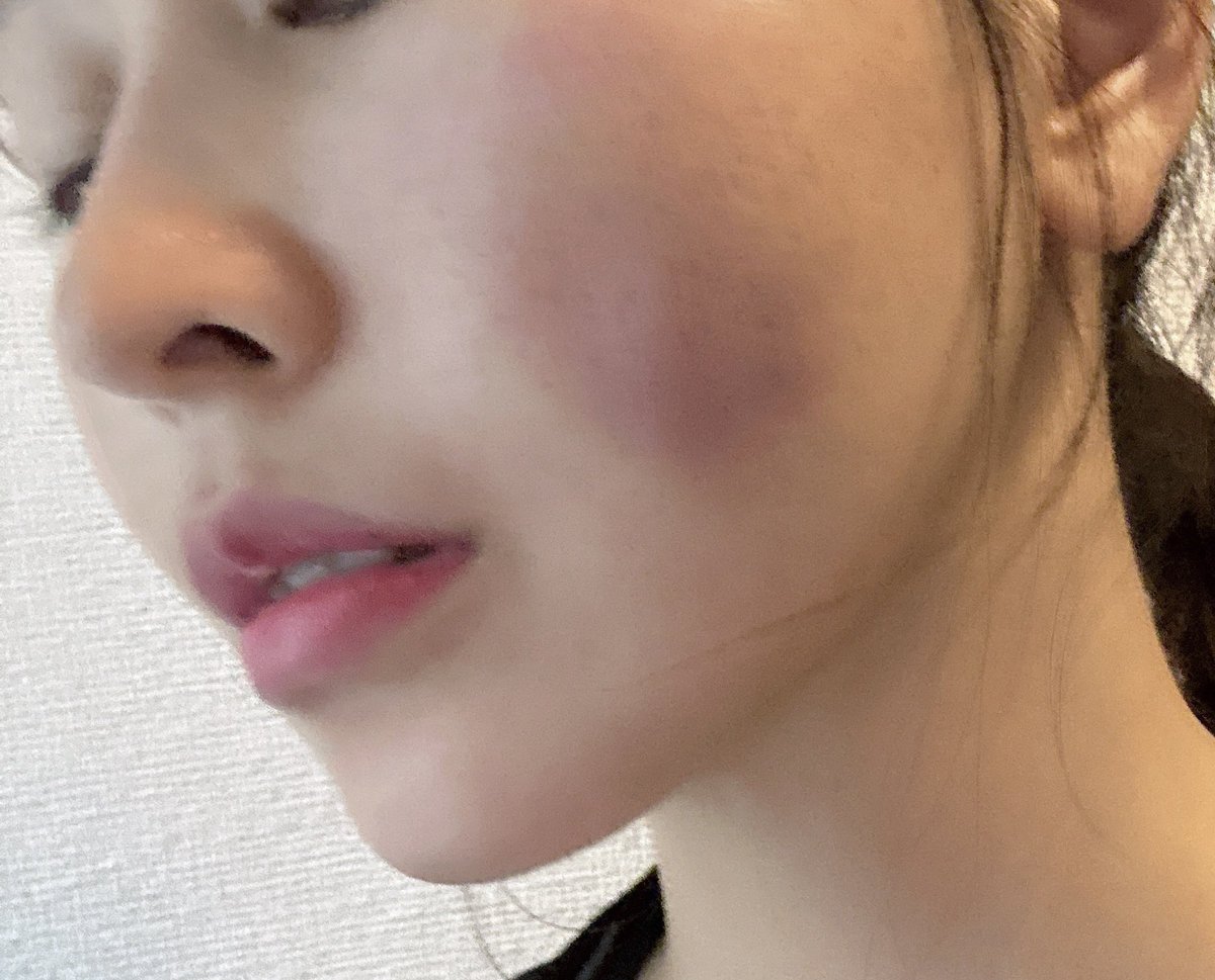 oniko___'s tweet photo. サブシジョン＋ヒアルロン酸DT1日目。内出血が黒くなってきた。触られたら結構痛いけど笑ったりするのは糸リフトと比べたら余裕 https://t.co/HMAXy8y8Ka