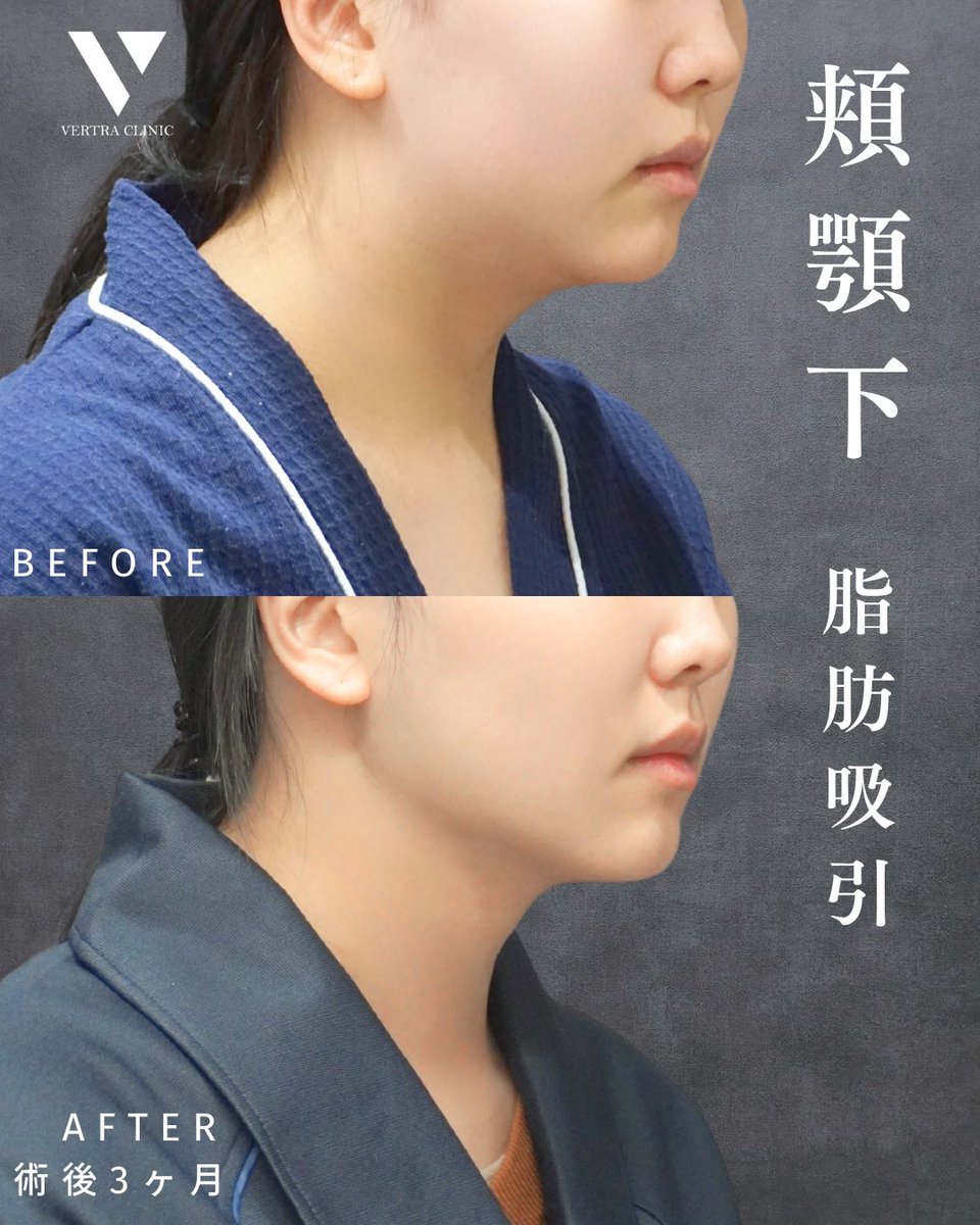 vertraclinic's tweet photo. 《 施術内容 》  
お顔の脂肪吸引＋糸リフト8本  
吸引部位 ：頬・顎下    

《 執刀医 》  
大阪院院長 河中 聡之(@Dr_kawanaka)    

《 詳細 》  
女性/20代/169cm/60kg https://t.co/5Fv79RNr8m