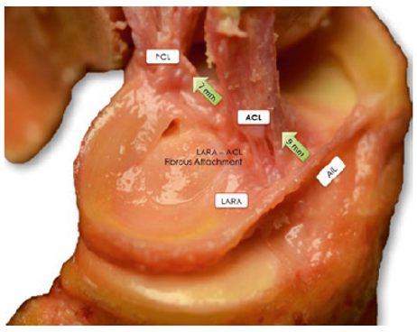 terapiamanualUE's tweet photo. 📏 En una cirugía de LCA, unos pocos milímetros pueden cambiarlo TODO.

Por eso los cirujanos estudian obsesivamente algo llamado “footprint” del ligamento cruzado anterior... https://t.co/HRkJpany83
